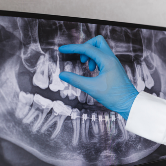 Dental Implant Post-Op Costs