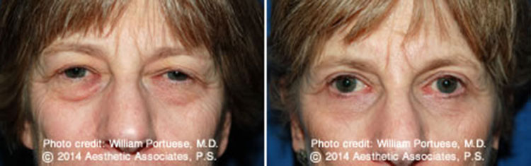 Eyelid Rejuvenation Surgery For Baggy Eyelids