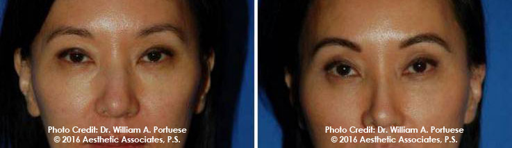 Cosmetic eyelid surgery 
