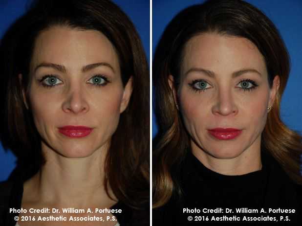 Eyelid Rejuvenation Surgery For Baggy Eyelids