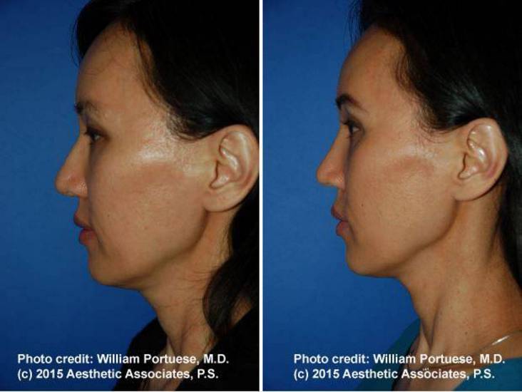 top facial plastic surgeon Portland Oregon