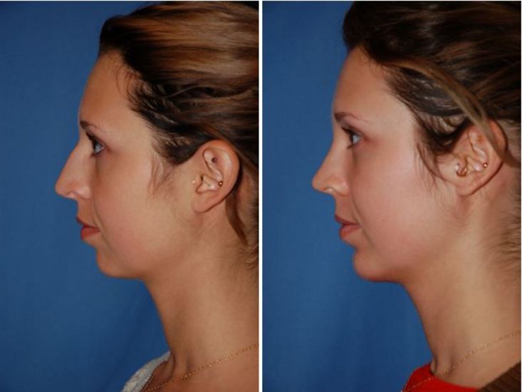 Top Nose Surgery Procedures