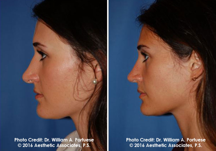 Nose Surgery Pacific Northwest