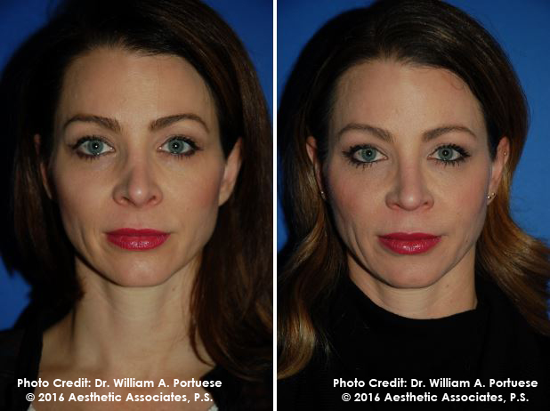 facial rejuvenation treatment Portland Oregon