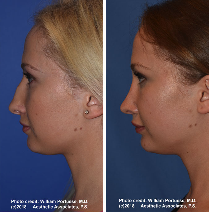 Nose Job