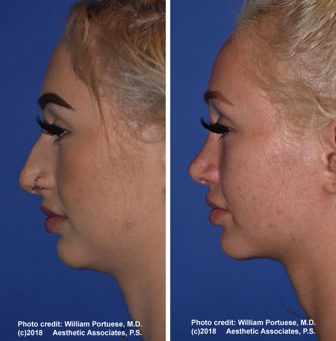 Nose Job