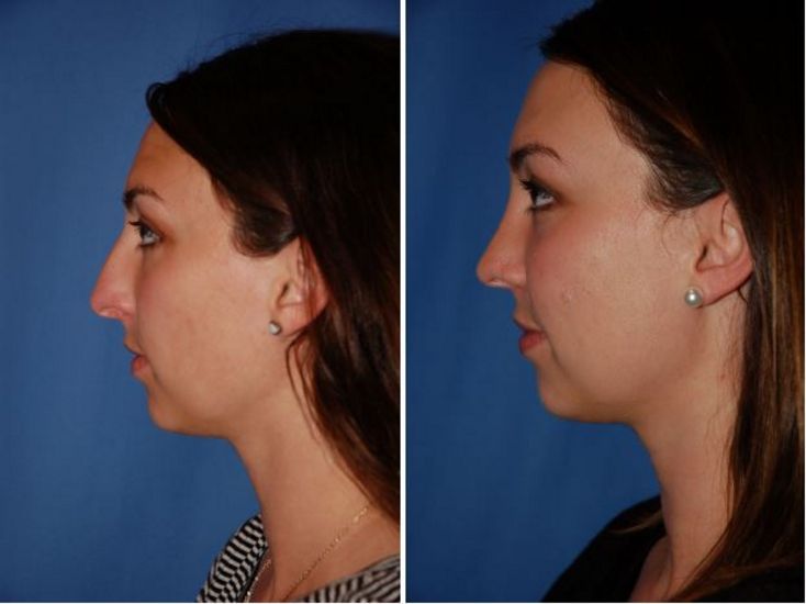 Nose Job Near Me