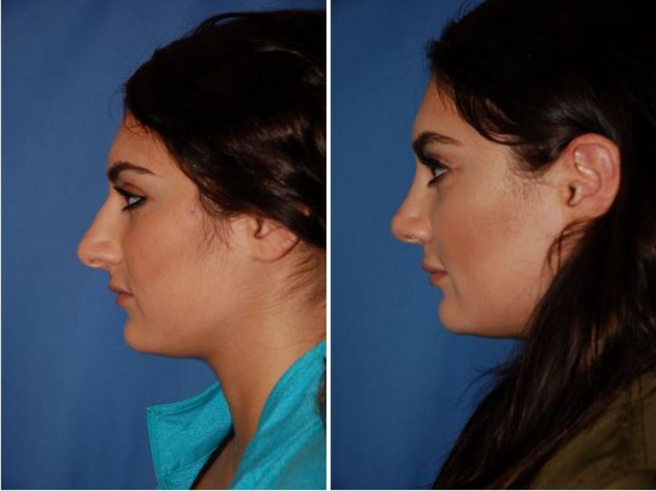 Nose Job Near Me