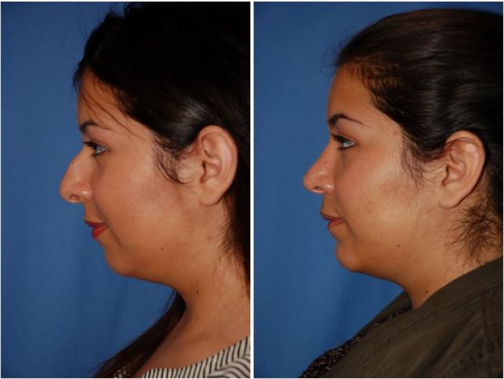 Nose Job Near Me