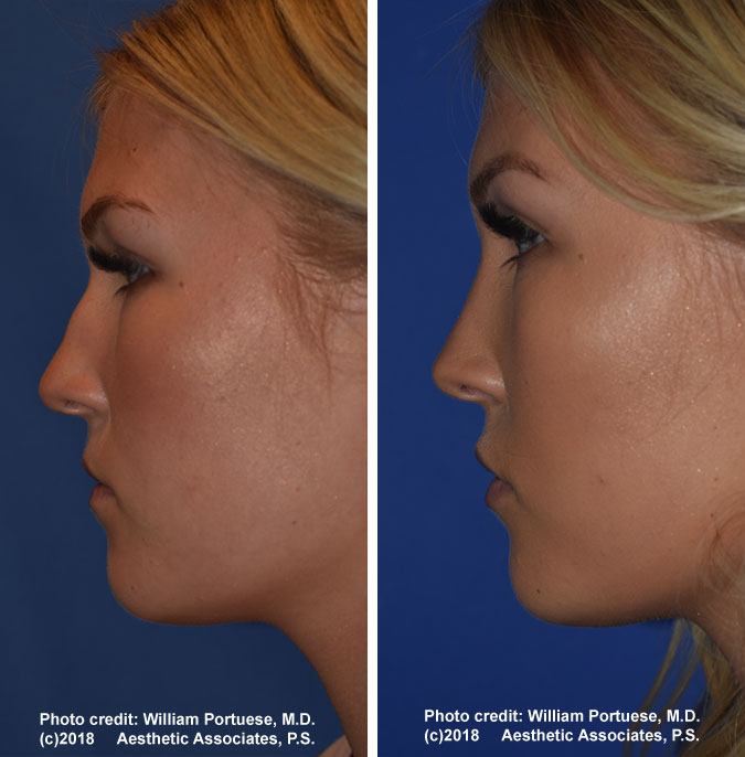 Nose Job Near Me