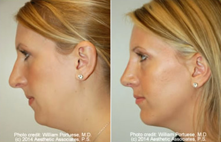 Rhinoplasty Oregon