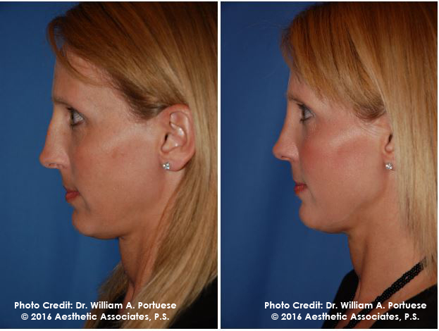 Rhinoplasty Oregon