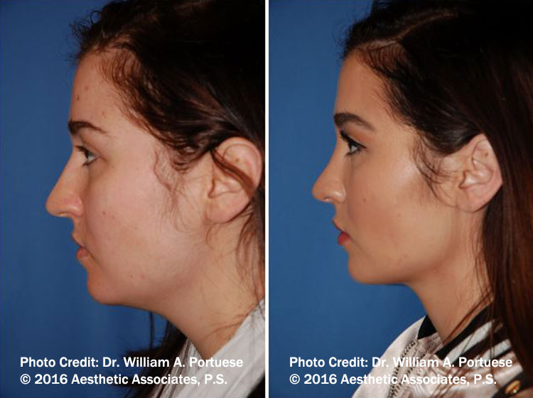 Rhinoplasty Oregon