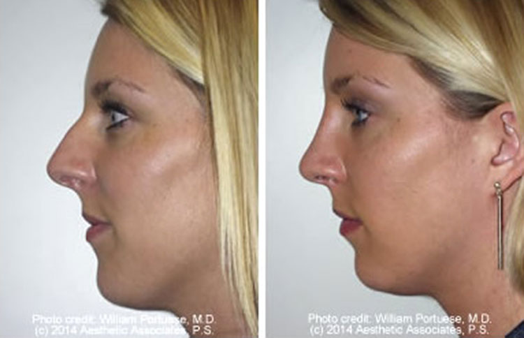 Rhinoplasty Oregon