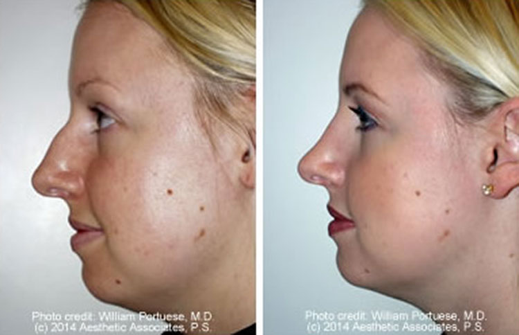 Rhinoplasty Oregon