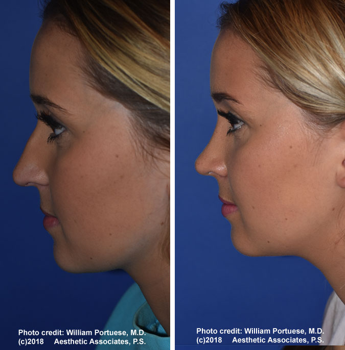 seattle facial plastic surgeon