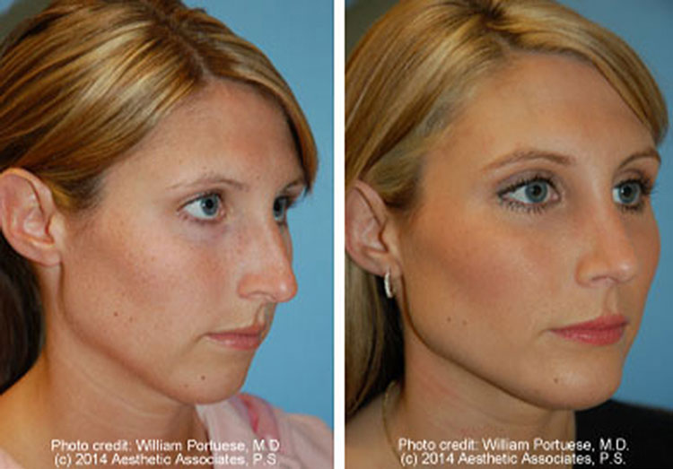 best rhinoplasty surgeon for bulbous tip