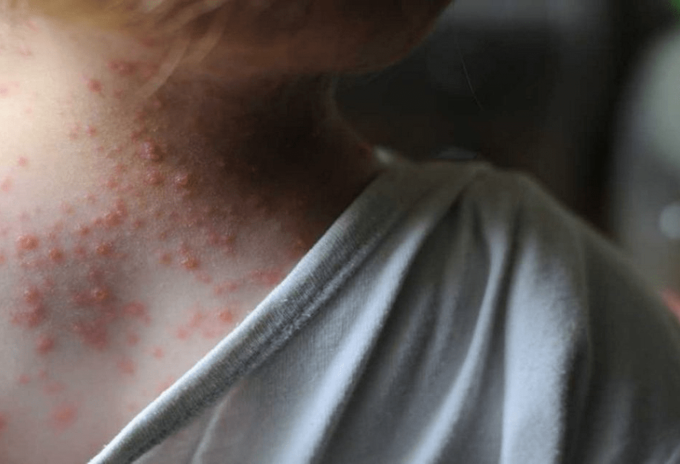 Confirman los primeros casos de la viruela del mono en Colombia