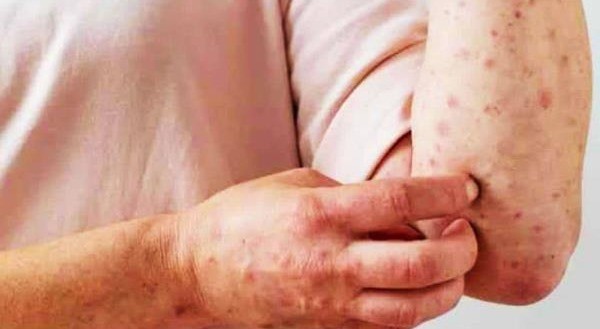 Confirman segundo caso de la viruela del mono en Ibagué