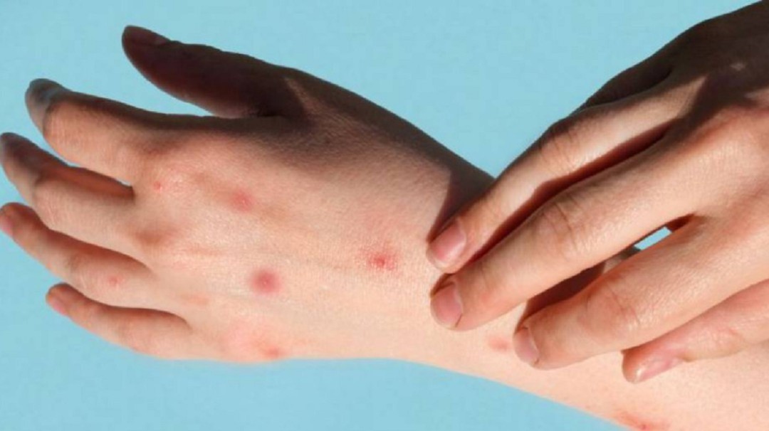 Dos nuevos casos de Viruela del Mono se registraron en Ibagué