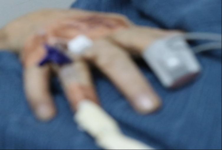 El Tolima registra 12 quemados con pólvora