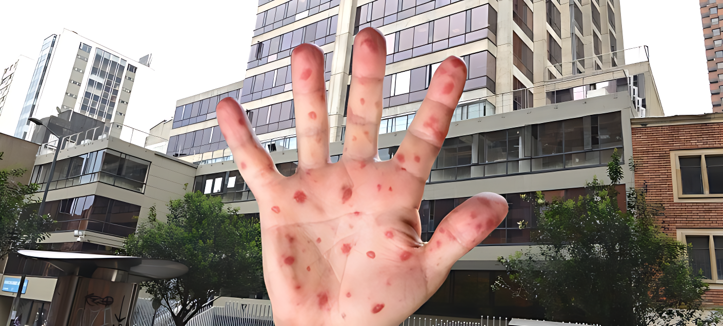 Alerta en Colombia por casos importados de sarampión