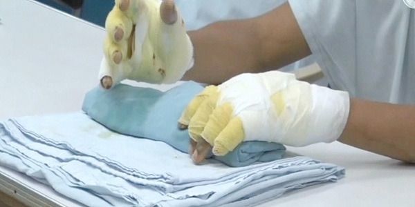 ¿Cómo tratar las quemaduras correctamente?