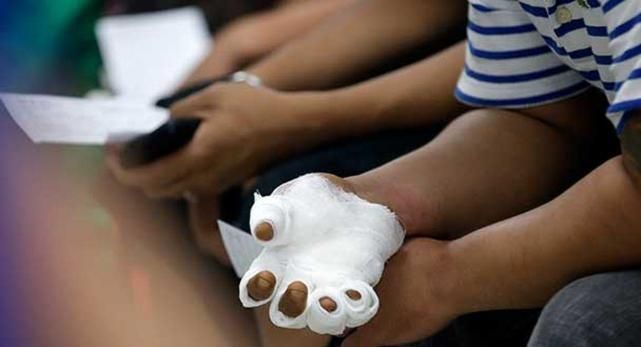 Secretaría de Salud mantiene monitoreo y prevención para evitar más quemados en el Tolima