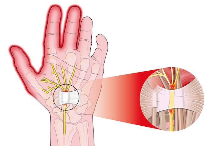 Síndrome del túnel del carpo