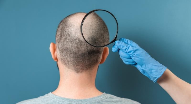 La pastilla contra la calvicie que aprobaron