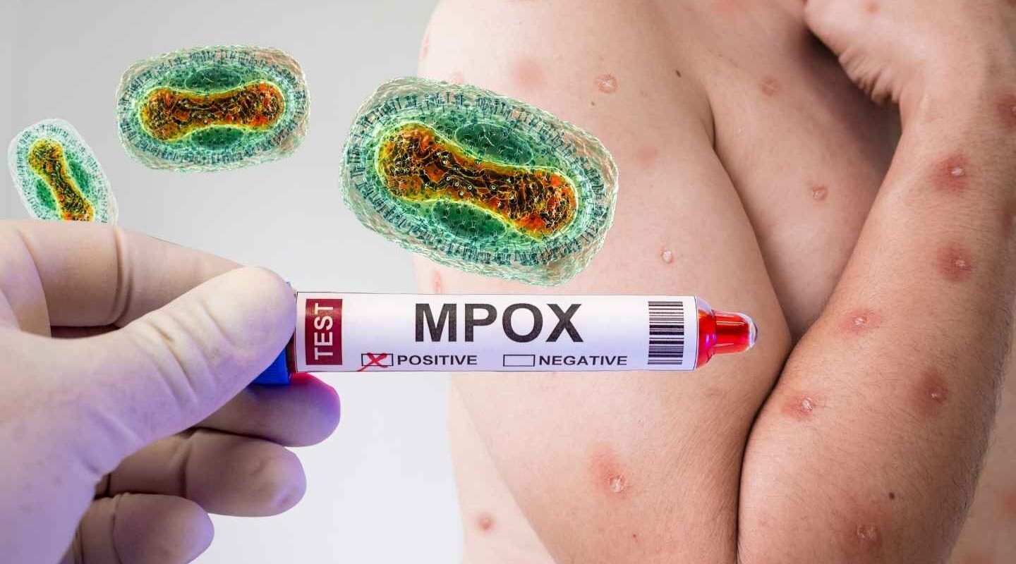 Colombia registra el primer caso de la nueva variante de la viruela del mono (mpox clado Ib)