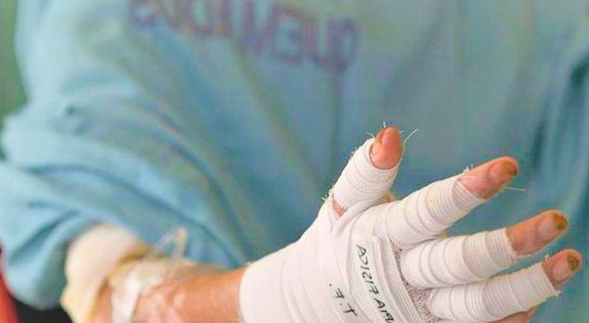 Reportan 18 casos de quemados por pólvora en el Tolima en diciembre