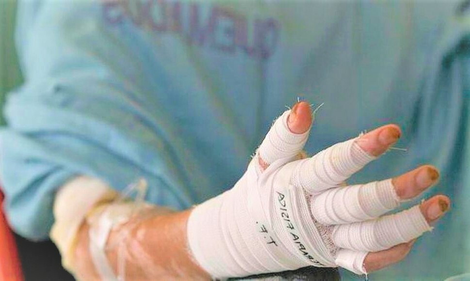 Siete quemados por pólvora en Ibagué en lo que va de diciembre