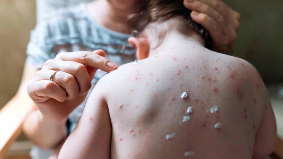 Viruela del mono, un problema de seguridad sanitaria mundial