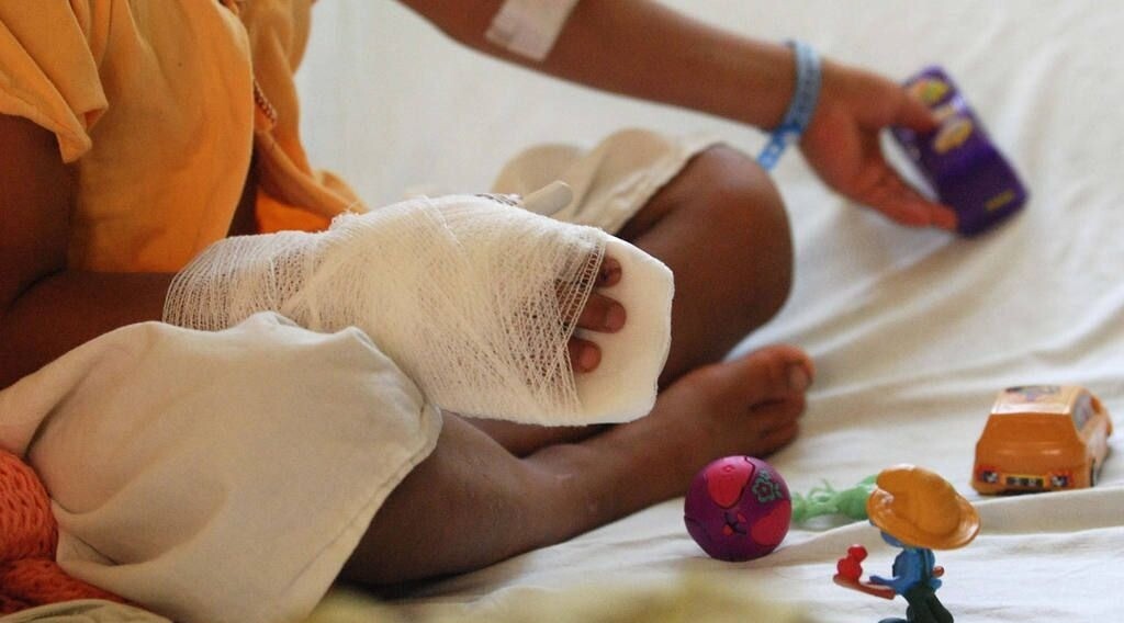 Nueve casos de quemados en el Tolima reactivan llamado a la prevención