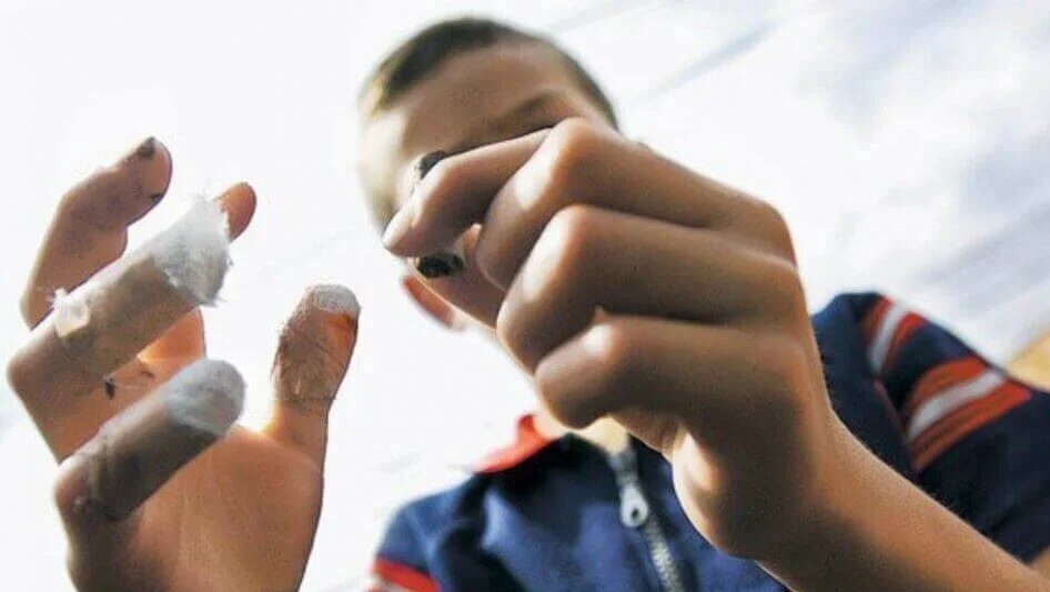 Las quemaduras con pólvora pueden dejar daños psicológicos que llegan a ser irremediables