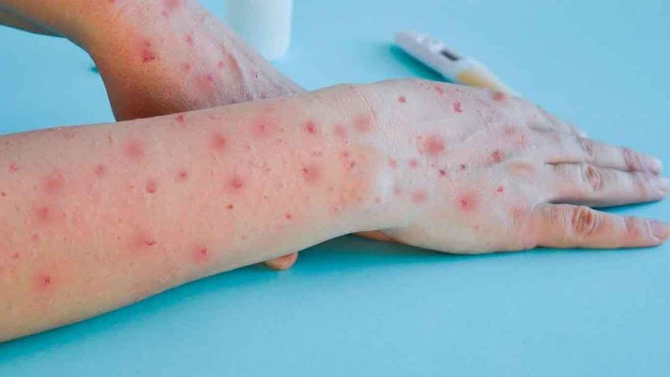 Ya son 20 los casos de viruela del mono en Colombia